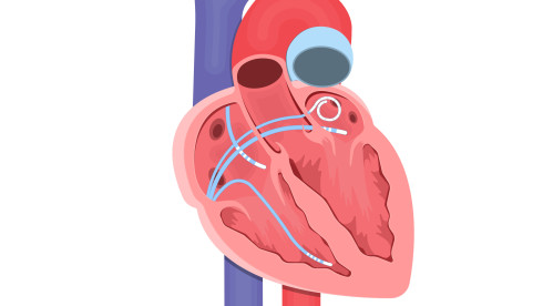 Thumbnail of Electrophysiology Study and Catheter Ablation